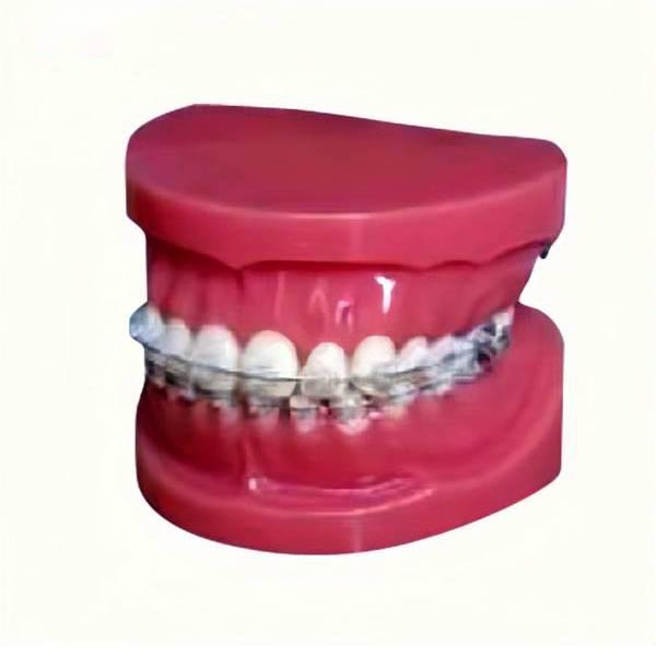 歯に固定ブレース付きUM-B17研究モデル (通常)
