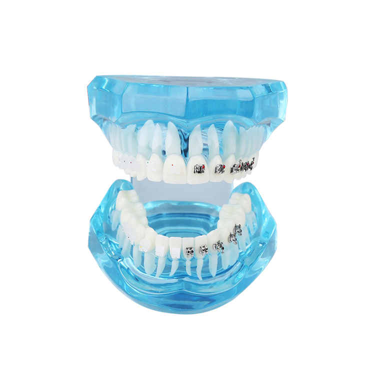 ブラケット付きUM-B21透明な歯科